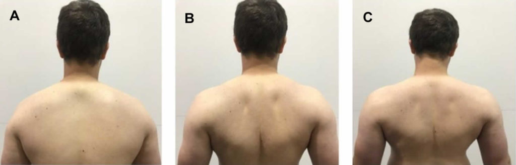 Thoracic outlet syndrome causes, symptoms, diagnosis, exercise & treatment