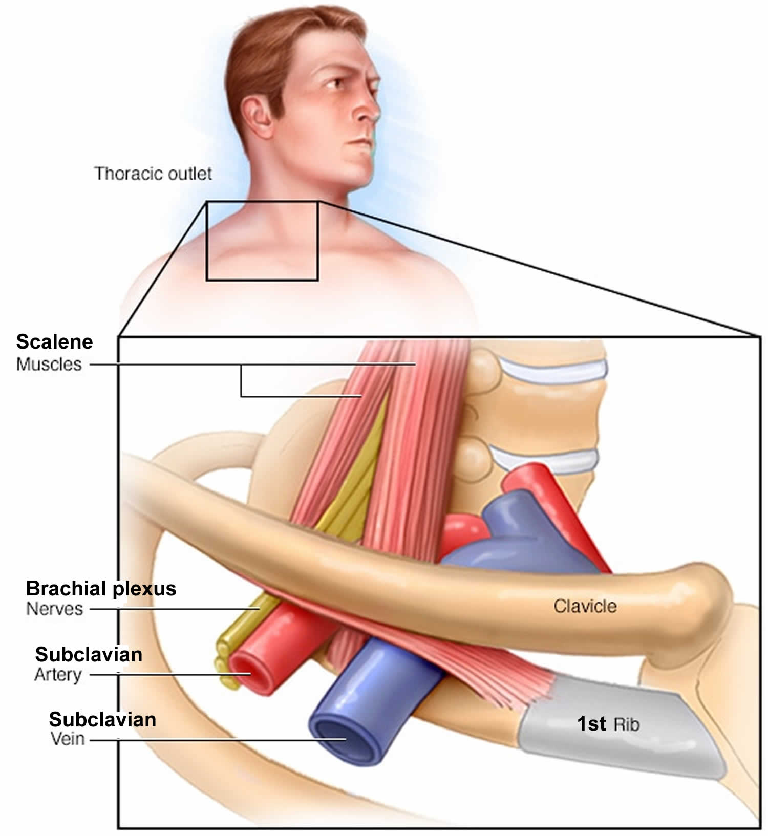 Thoracic outlet syndrome - WikiLectures