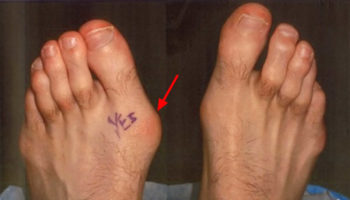 turf toe