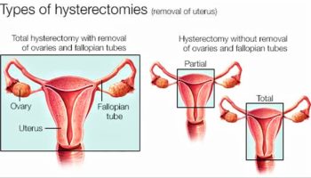 types of hysterectomy