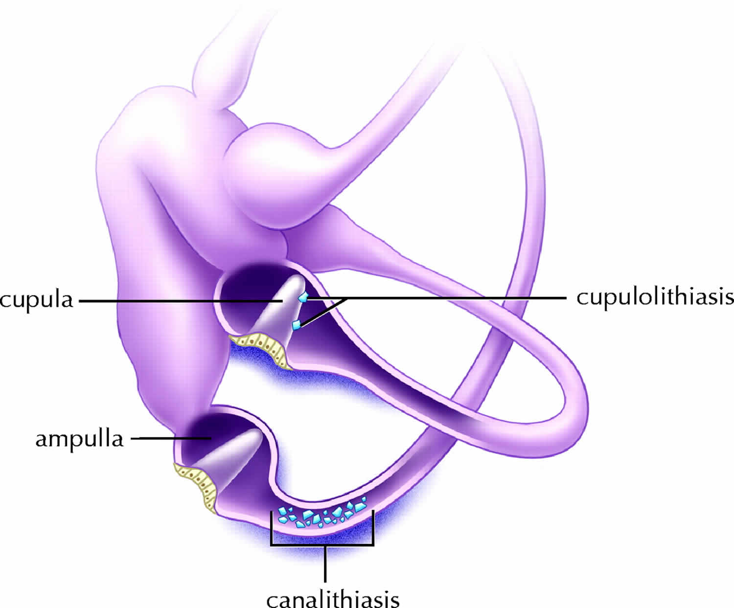 What Causes Benign Positional Vertigo