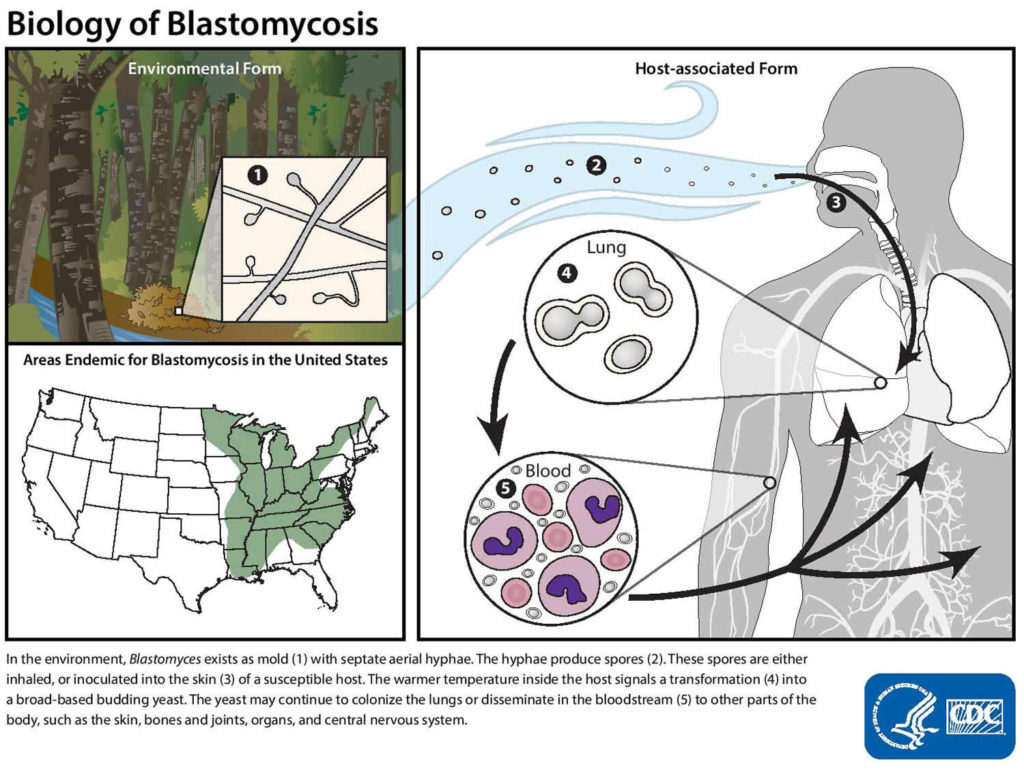 Blastomycosis In Humans Causes Symptoms Diagnosis And Treatment 