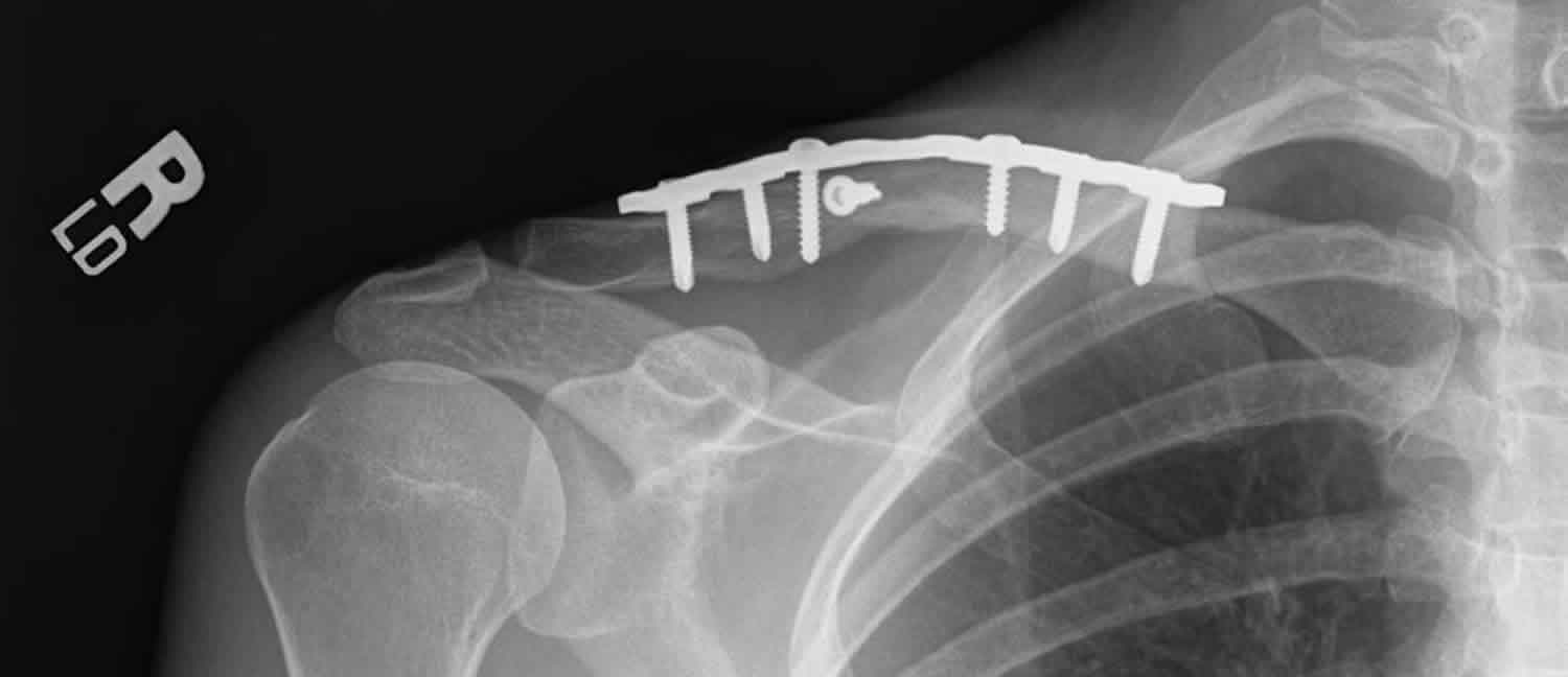 Broken collarbone plates and screws