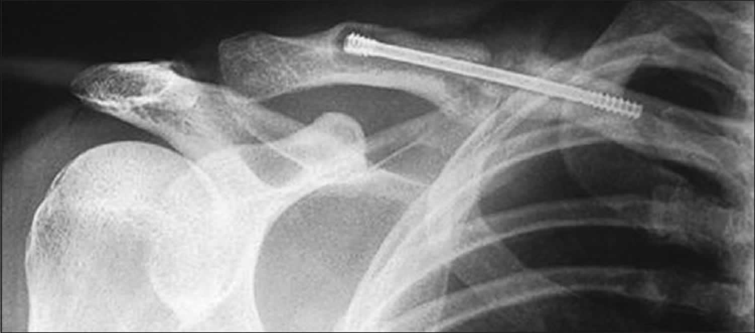 Broken Collarbone Or Clavicle Fracture Signs Symptoms And Treatment