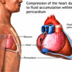 Cardiac tamponade