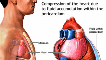 Cardiac tamponade