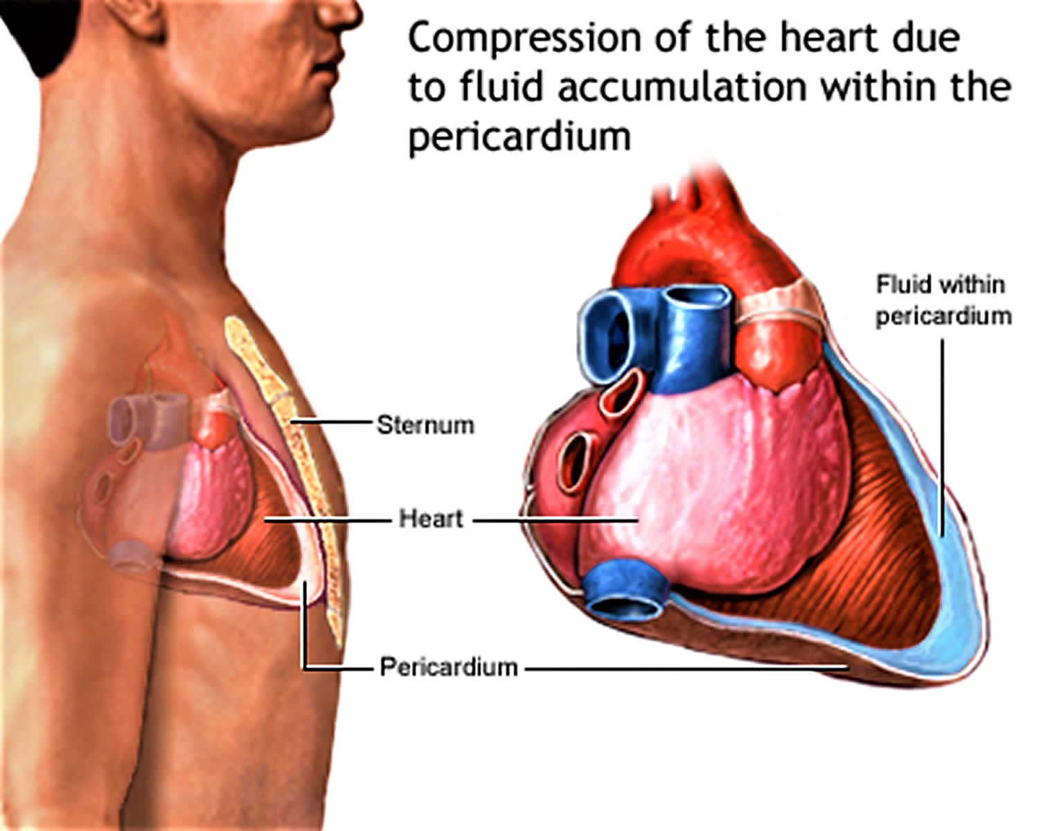 Скопление воздуха и крови в перикарде. Перикардит (воспаление наружной сердечной оболочки). Сердечная сумка перикард. Перикард (околосердечная сумка). Осложнения перикардита.