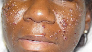 Cryptococcosis