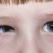 Duane syndrome