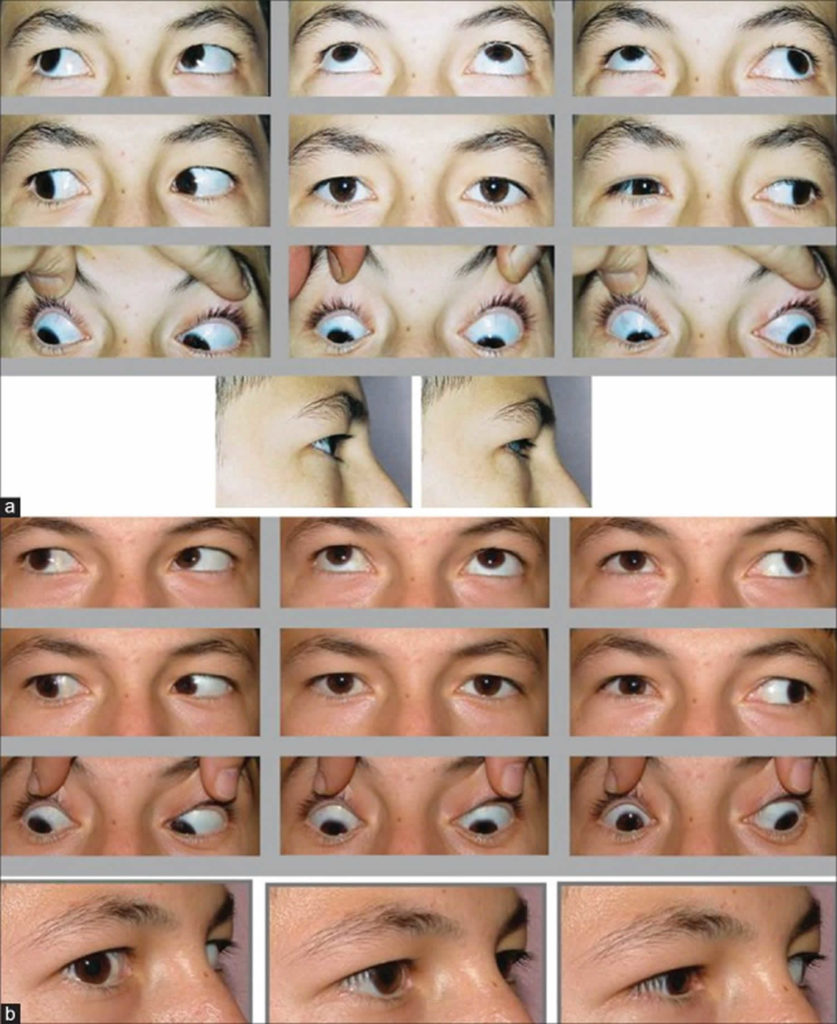 Duane syndrome, Duane Retraction syndrome causes, diagnosis & treatment