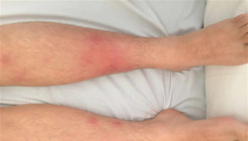 Erythema nodosum