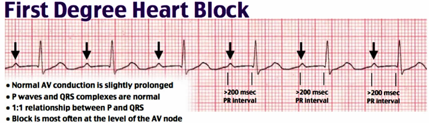 heart-block-causes-symptoms-types-diagnosis-and-heart-block-treatment