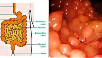 Gardner syndrome