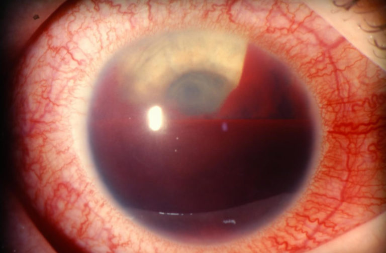 Hyphema causes, symptoms, grading, complications, recovery & treatment