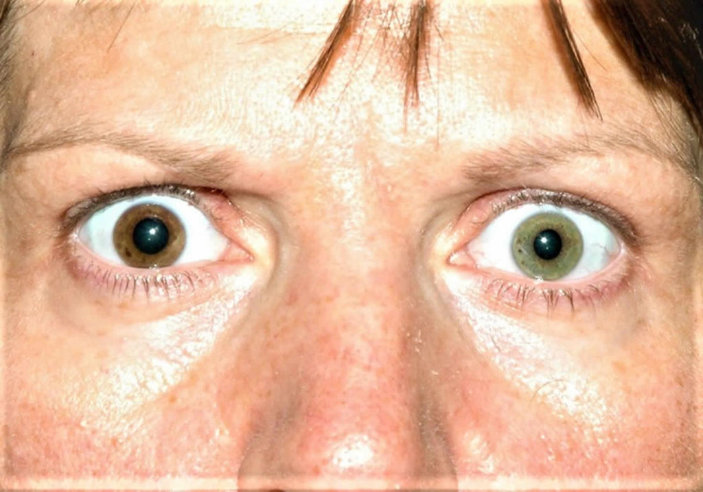 Heterochromia Eyes In Humans Causes How Rare Is Heterochromia Iridis