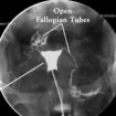 Hysterosalpingogram