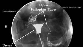 Hysterosalpingogram