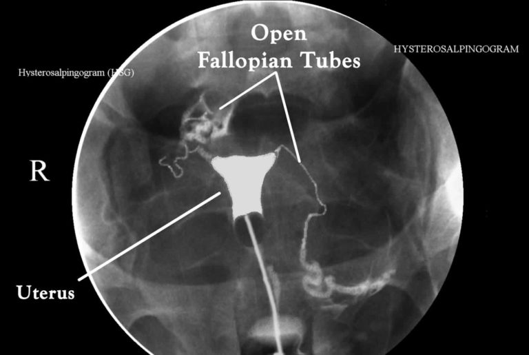 Hysterosalpingogram procedure, uses & hysterosalpingogram side effects