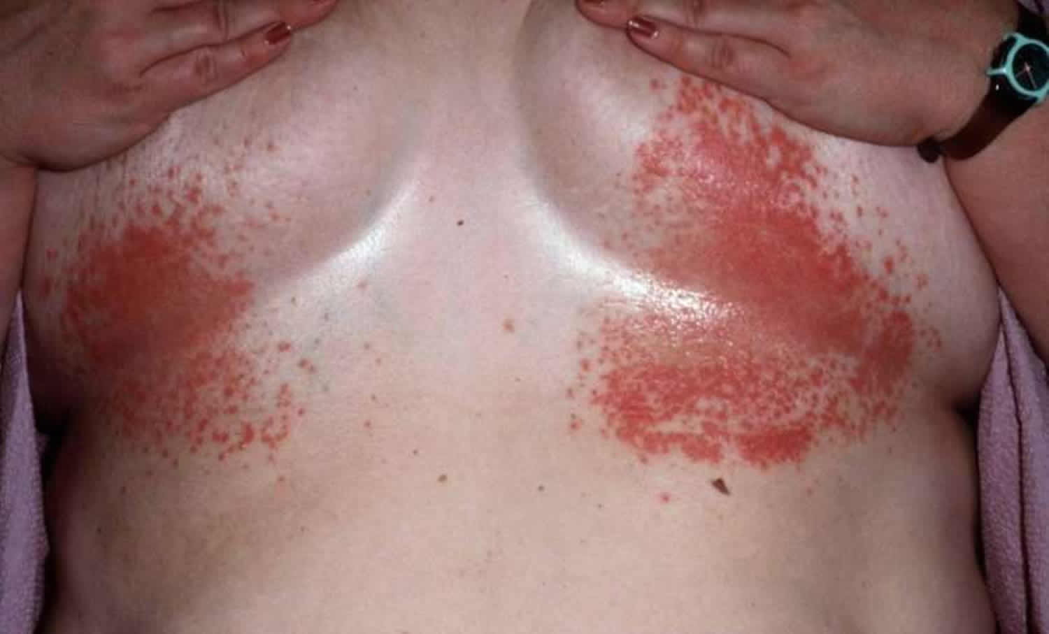 кожа груди чешется у женщин фото 94