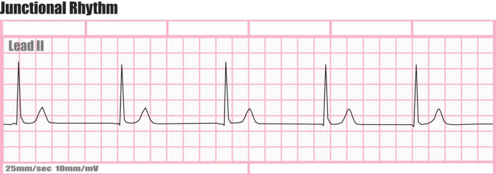 Holter monitor uses, instructions, preparations and Holter monitor results