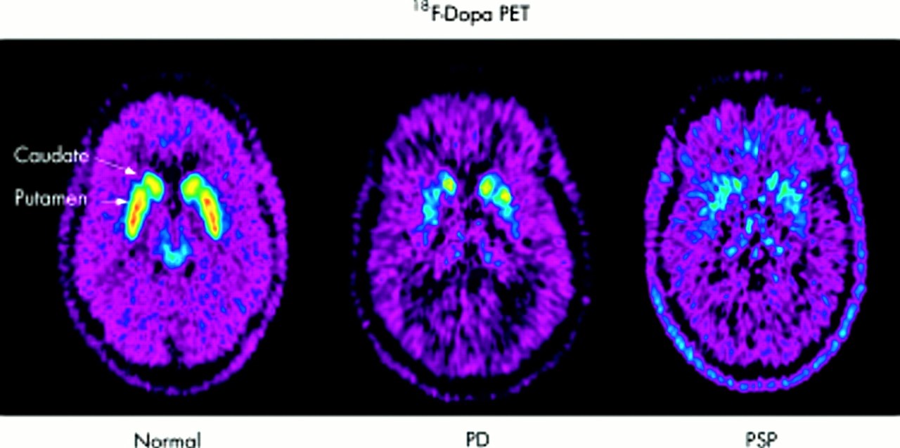 PET scan brain