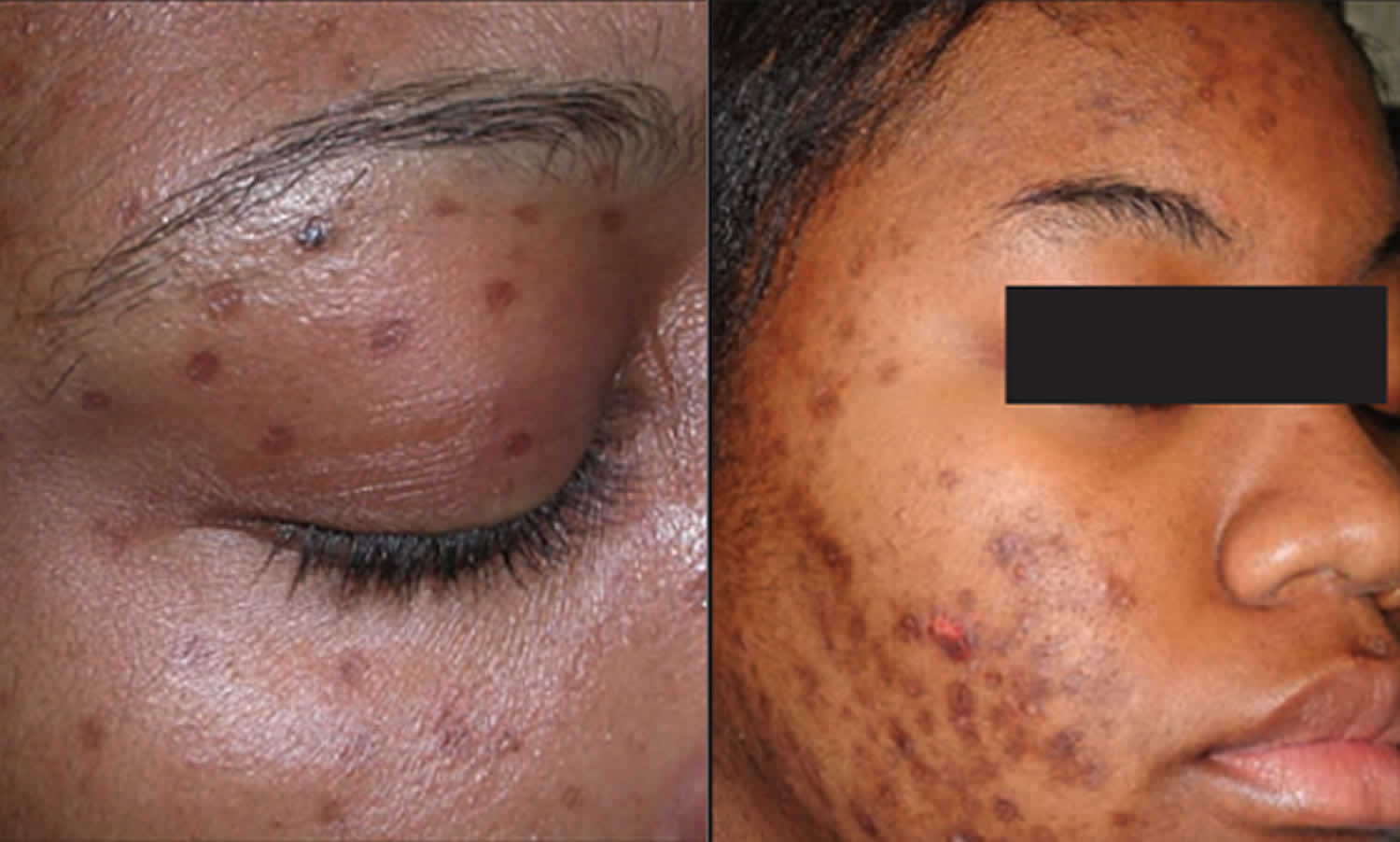 How To Cover Hyperpigmentation On Dark Skin Clear Hyperpigmentation