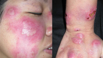 Sweet syndrome rash