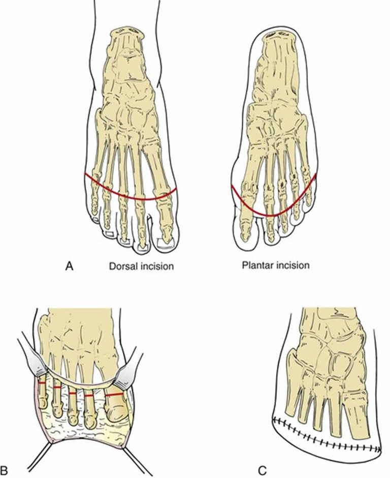 Amputation causes, types of amputation and amputation complications