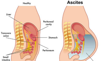 ascites