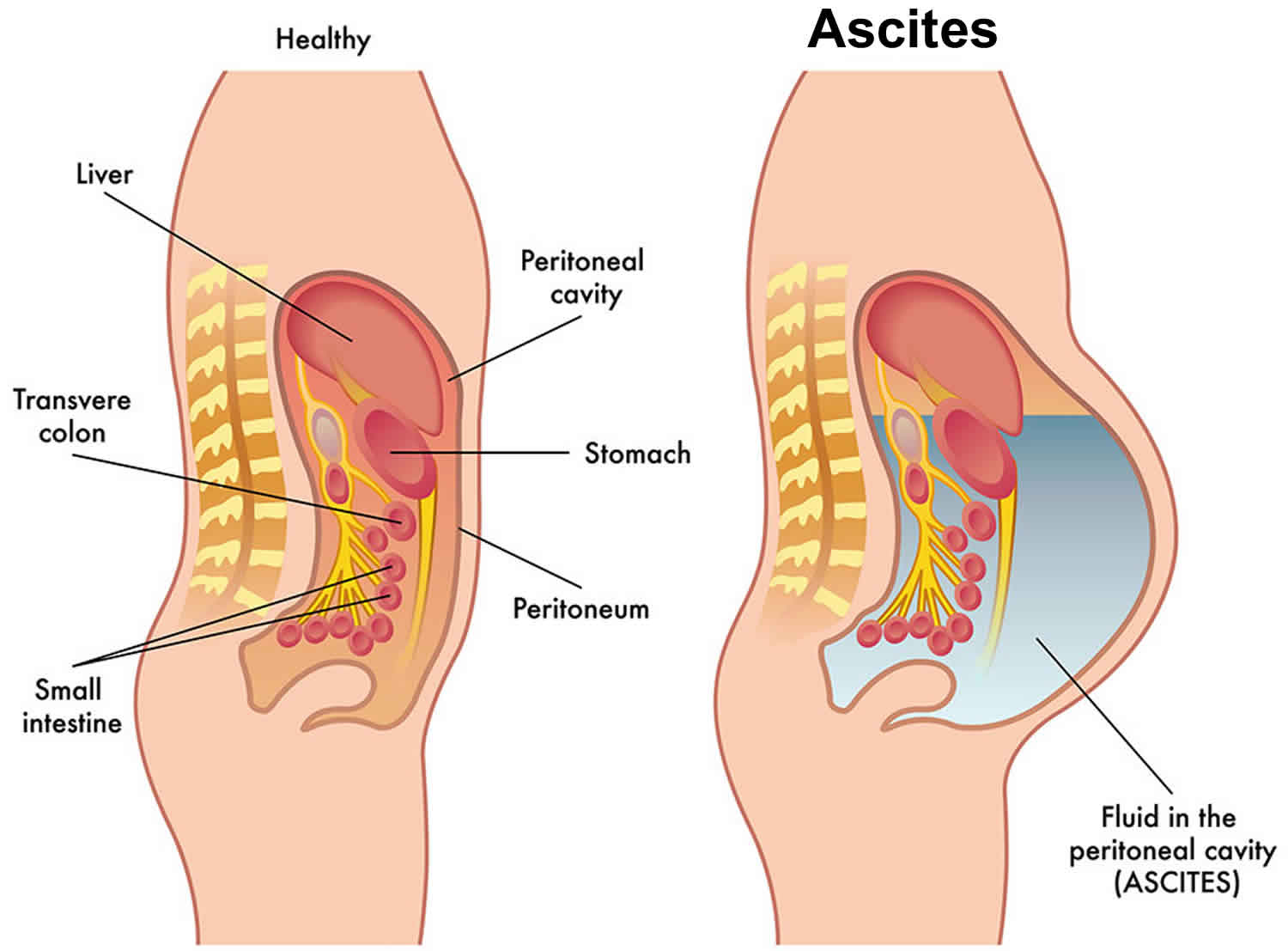 ascites-causes-symptoms-diagnosis-prognosis-and-ascites-treatment