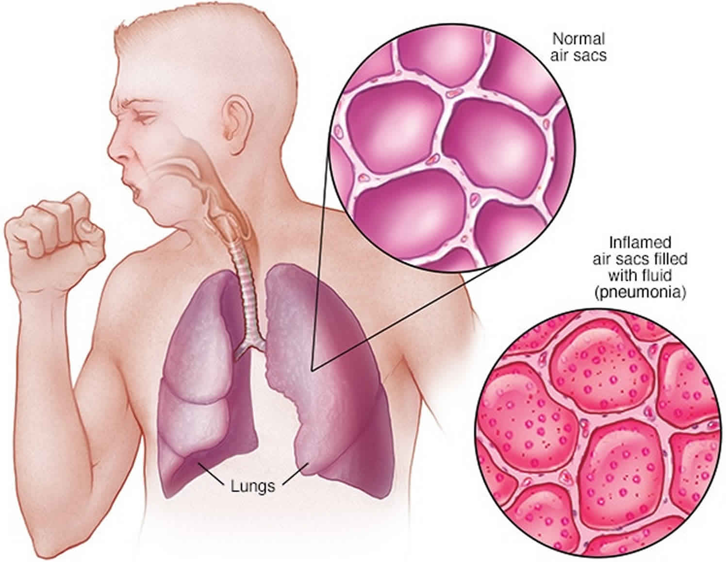 Pneumonia. Пневмония.