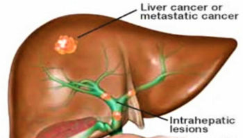 bile duct obstruction