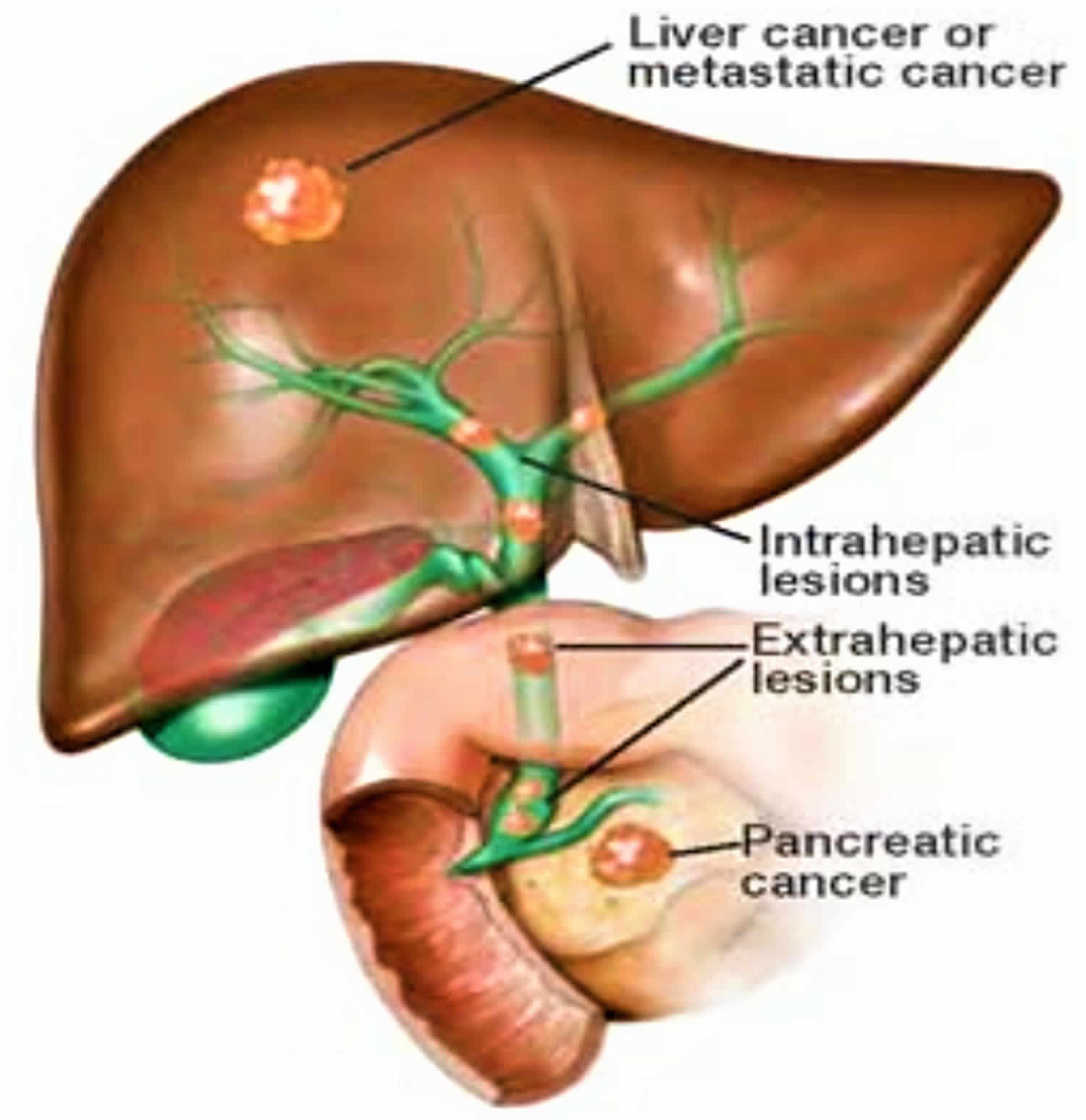 Bile Duct Obstruction Causes Symptoms Treatment Bile Duct Obstruction My Xxx Hot Girl