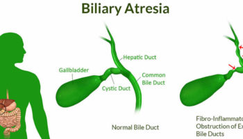 biliary atresia