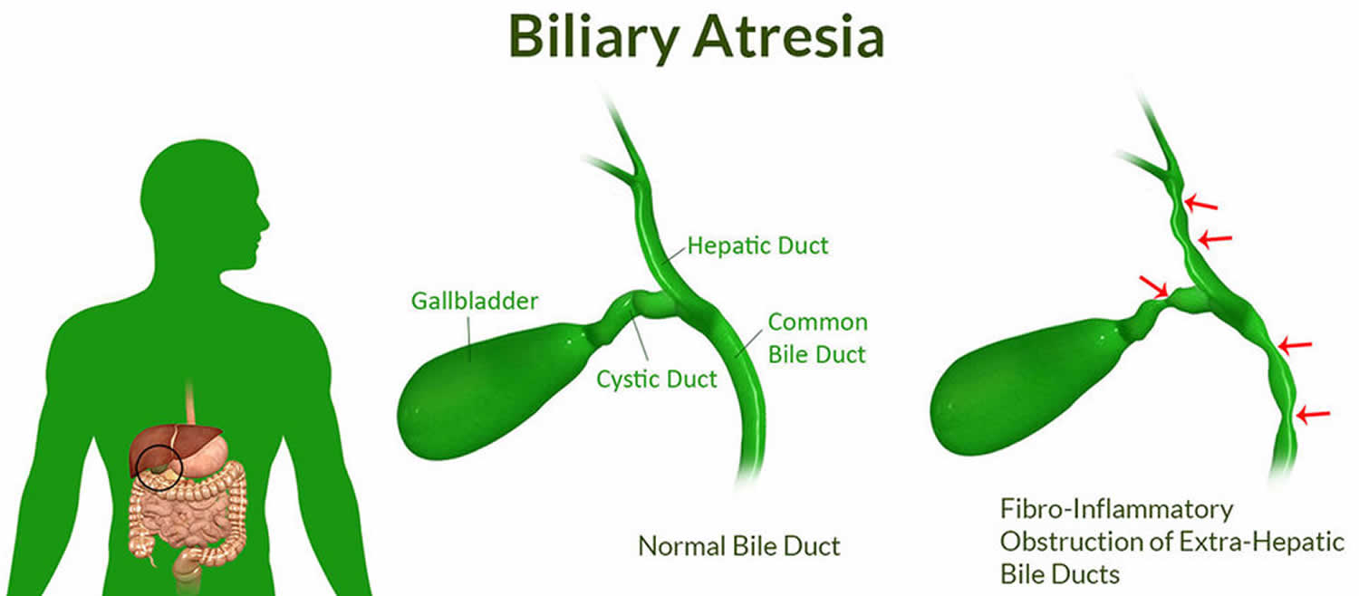 Biliary atresia causes, symptoms, prognosis and biliary atresia treatment