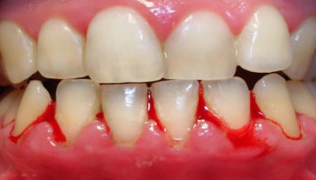 bleeding gums