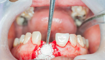 bone graft