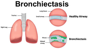 bronchiectasis