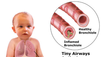 bronchiolitis