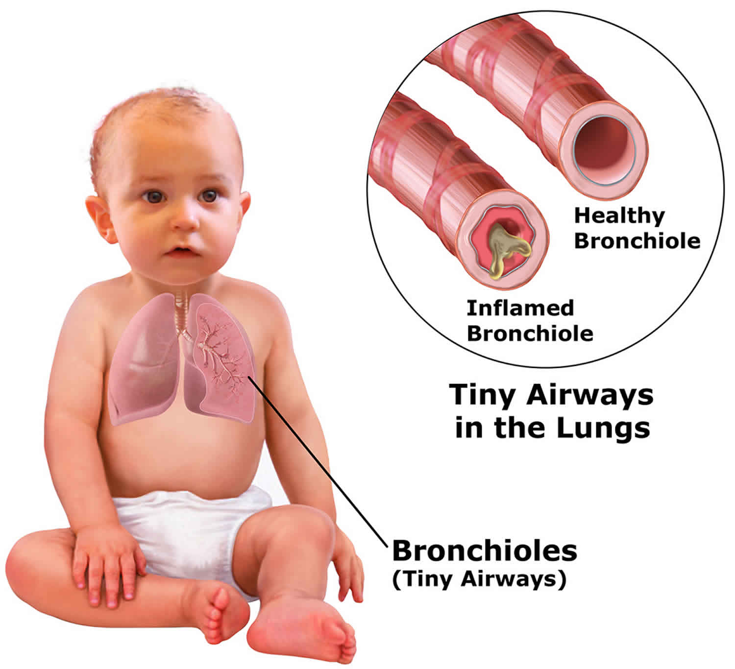 How Long Does Bronchiolitis Take To Develop In Babies: A Complete Guide