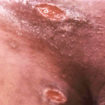 chancroid sores