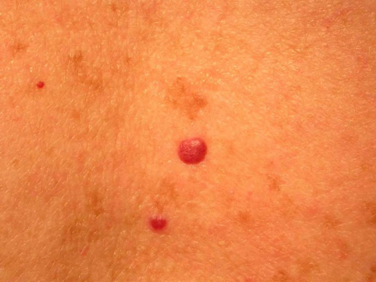 Cherry angioma causes, symptoms, diagnosis & cherry angioma treatment