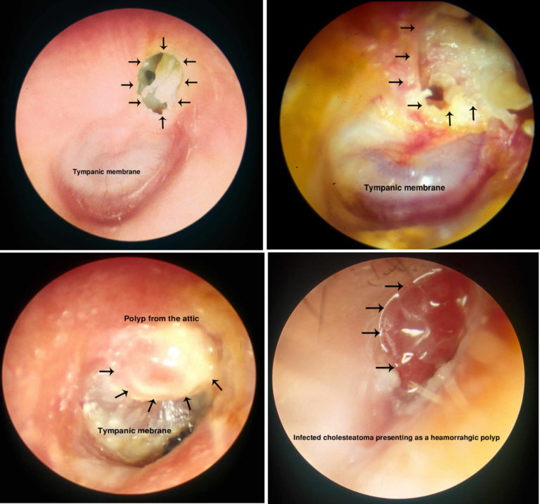 Cholesteatoma ear causes; symptoms; diagnosis & cholesteatoma treatment