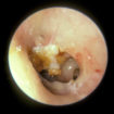 cholesteatoma ear