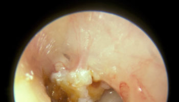 cholesteatoma ear