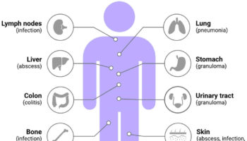 chronic granulomatous disease