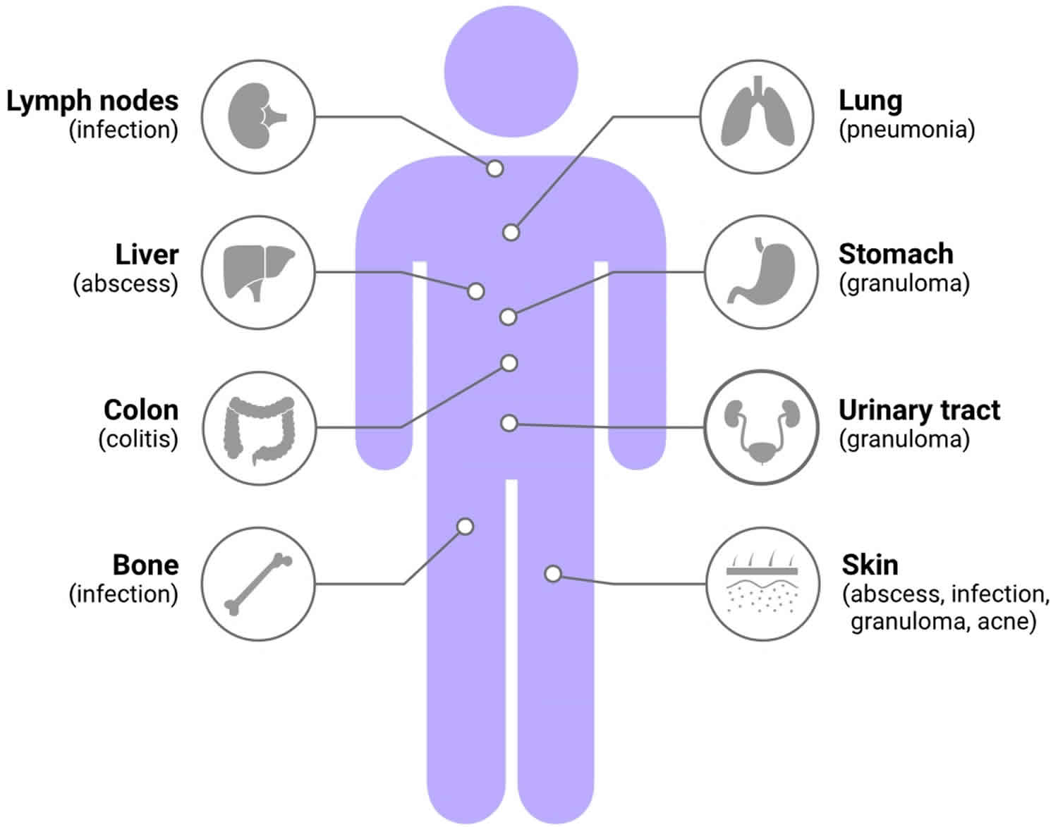 Chronic Granulomatous Disease Causes Symptoms Diagnosis And Treatment