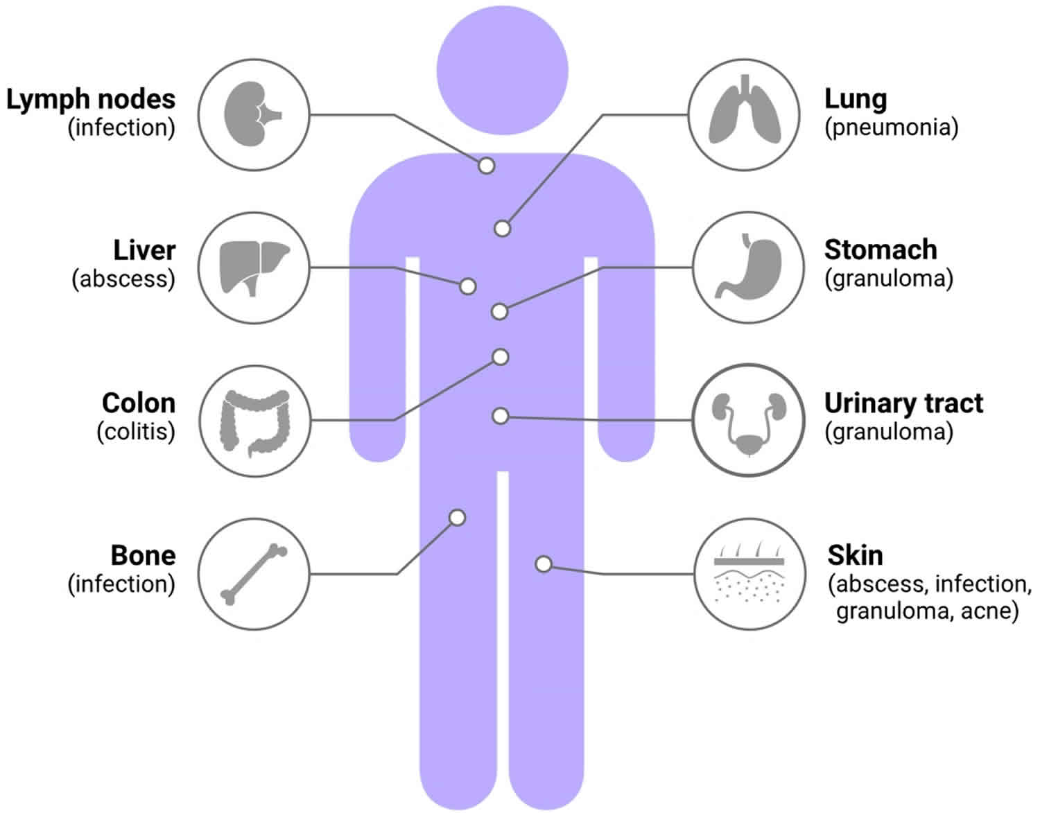 Chronic Granulomatous Disease Causes Symptoms Diagnosis Treatment