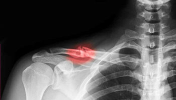 clavicle fracture