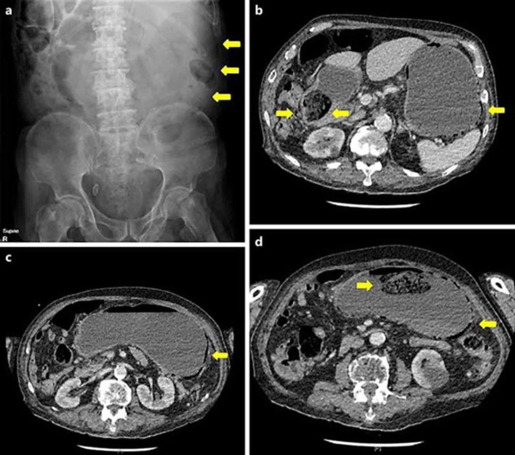 Bezoar, gastric bezoar causes, symptoms, diagnosis and bezoar treatment